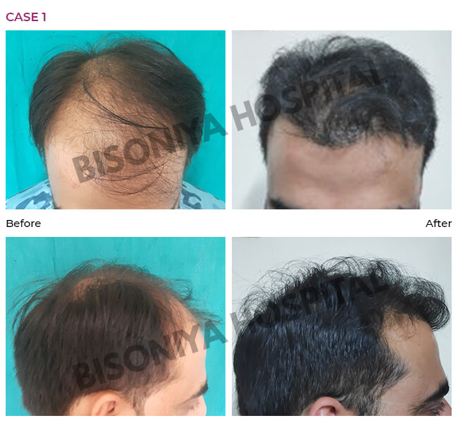 Bisoniya - Hair Transplant Unit