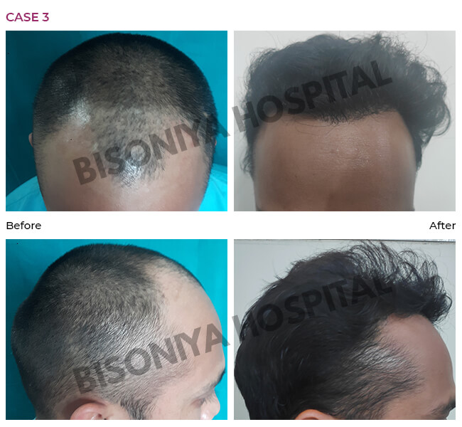 Bisoniya - Hair Transplant Unit