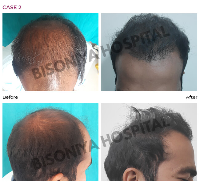 Hair Transplant Bhopal - Case2