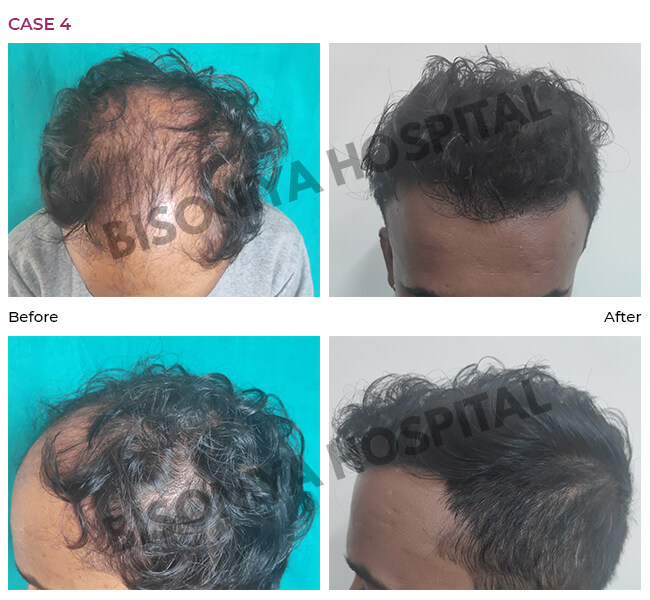 Hair Transplant Bhopal - Case4
